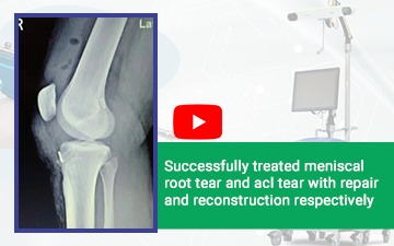 Meniscal root tear and ACL tear with repair and reconstruction respectively